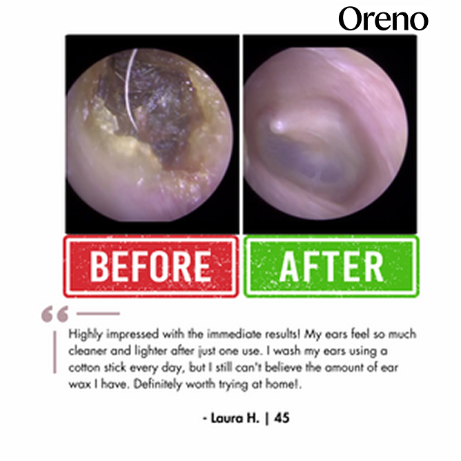 Oreno™ Electric Ear Wax Removal Kit