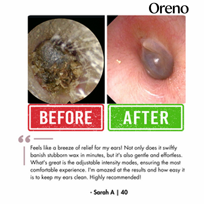 Oreno™ Electric Ear Wax Removal Kit
